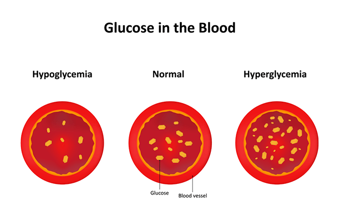 Hypoglycaemia Without Diabetes: Symptoms, Causes, and Treatment ...