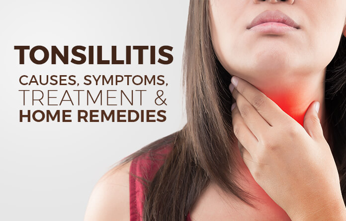 Tonsillitis Types Causes Symptoms Treatment And Home Remedies